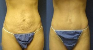 New York Abdomen Liposuction Body Sculpt