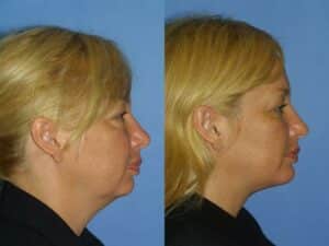 NYC Neck Lift Surgical Augmentation