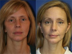 NYC Browlift Surgery Anti-Aging