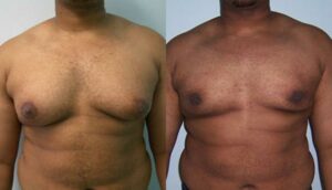 NYC Male Breast Reduction Surgery