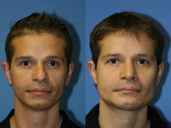 cheekbone implants men before and after