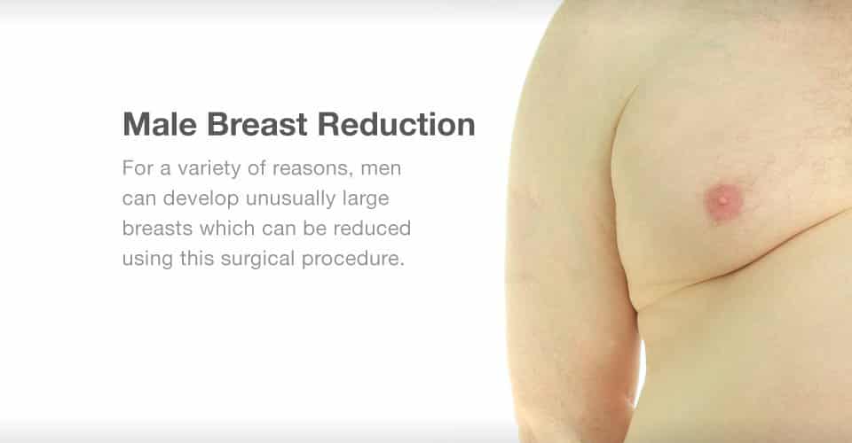 Breast reduction (mammoplasty) - Series—Indications: MedlinePlus Medical  Encyclopedia