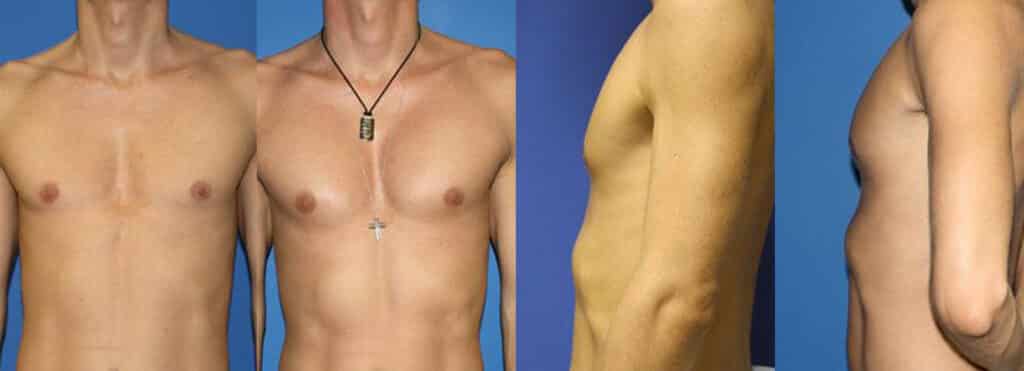 Before / After images of a young man after body contouring procedure. After the procedure, six packs are more visible and chest and other muscles are more prominent, giving an athletic outlook, New York, NY
