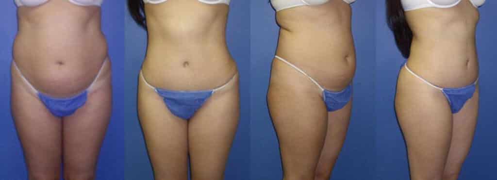 Images of a young female comparing her body before and after tummy tuck procedure. The belly fat is removed and the body is toned, New York, NY
