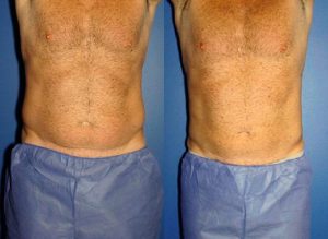 CoolSculpting® for Men  Advanced Skin & Body Solutions