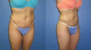 liposuction before and after new york