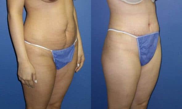 tummy tuck results new york