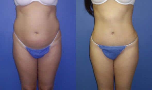 Body Contouring Procedures After Pregnancy and Childbirth