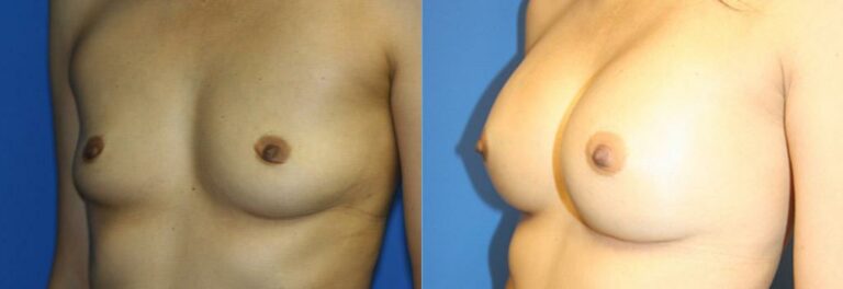 patient-749-breast-augmentation-before-after-1