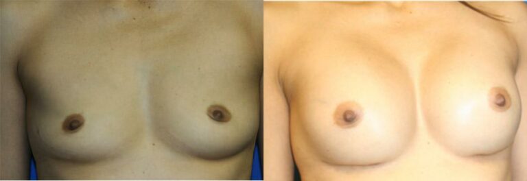 patient-749-breast-augmentation-before-after
