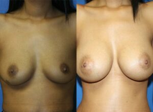 breast augmentation before and after