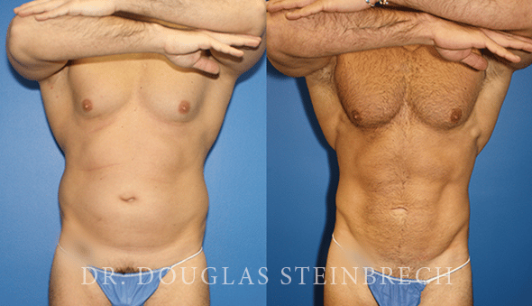 Before and After Liposuction by Dr. Steinbrech