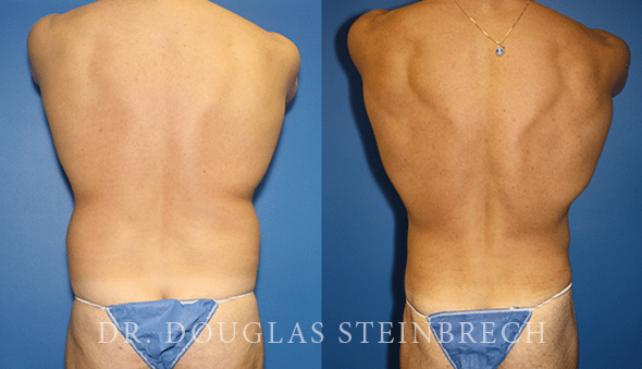 Before and After Liposuction by Dr. Steinbrech