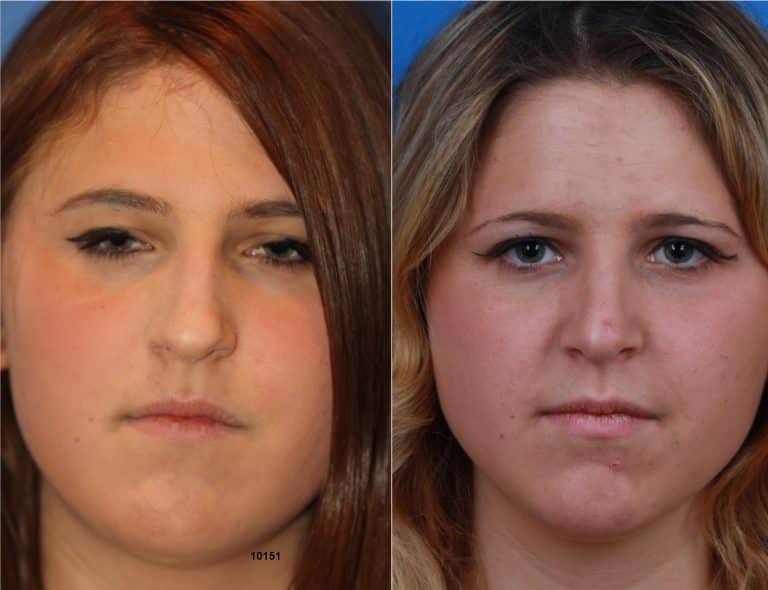 Rhinoplasty with Dr. Miller