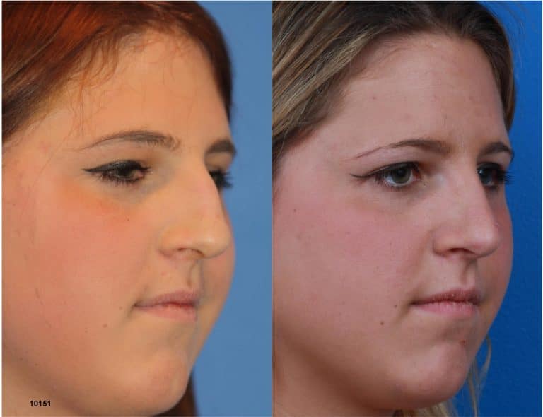 Rhinoplasty with Dr. Miller