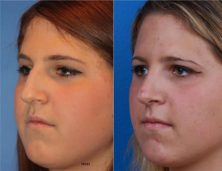 Rhinoplasty with Dr. Miller