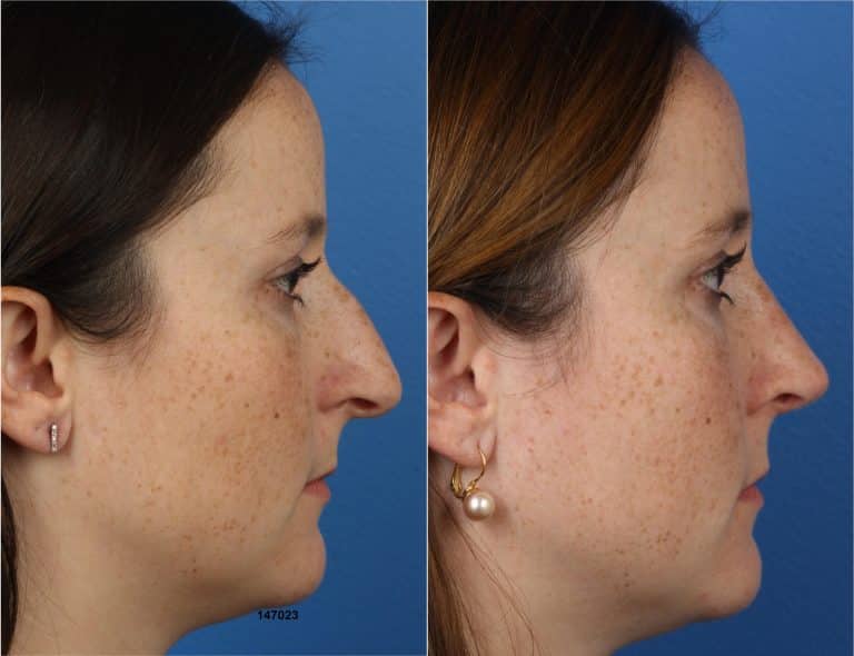 Rhinoplasty to remove dorsal hump and refine tip with Dr. Miller