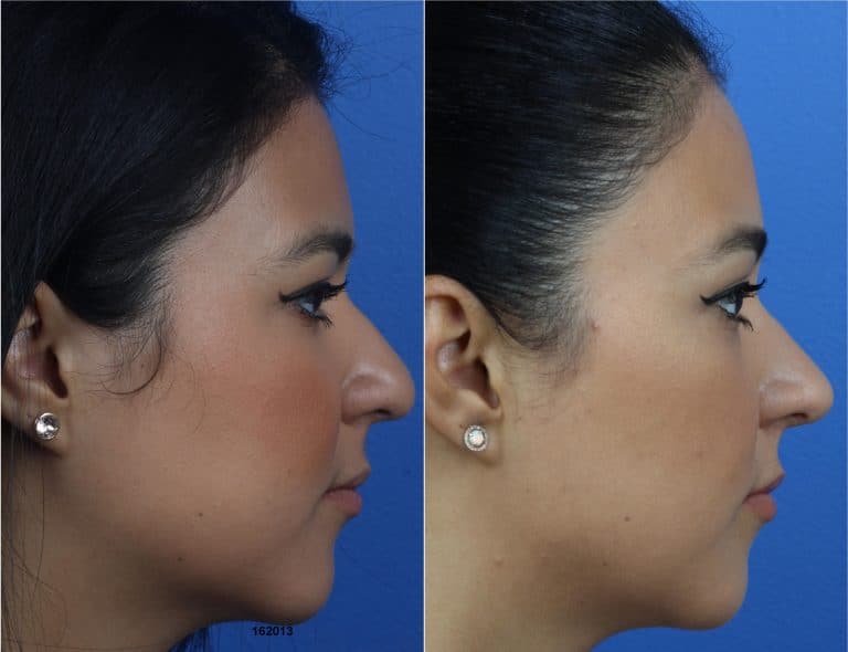 Rhinoplasty and Buccal Fat Removal with Dr. Miller