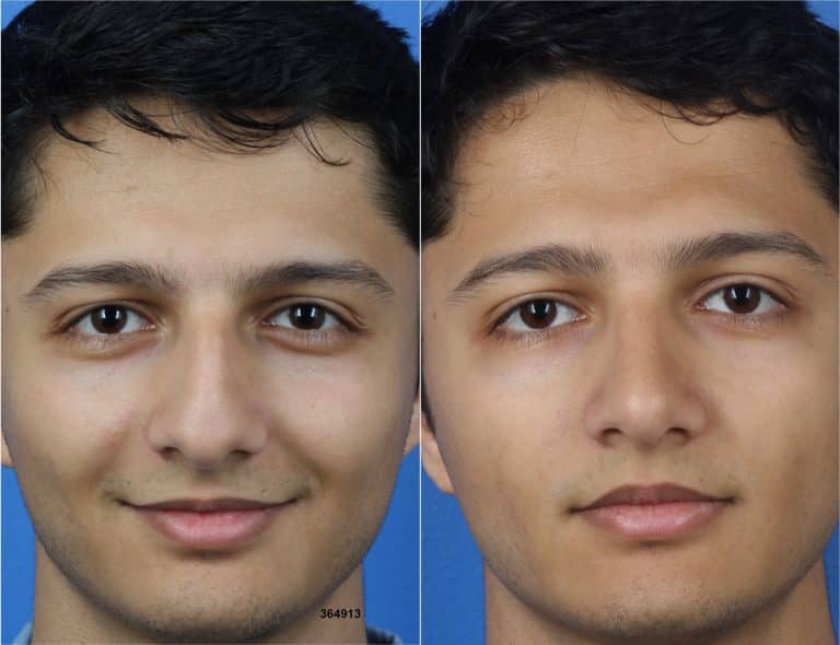 Rhinoplasty with Dr. Miller