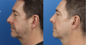 Gotham Plastic Surgery Male Facial Contouring New York NY