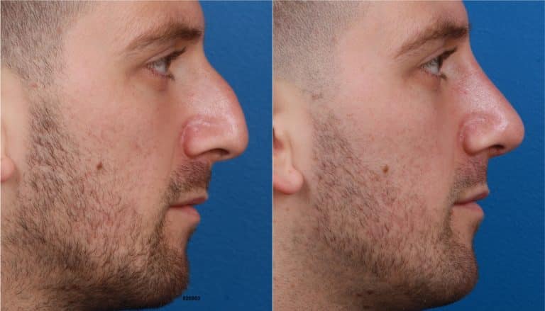 NatraNose with Rhinoplasty
