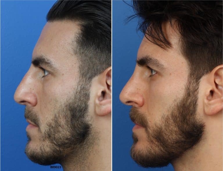 Before and After Photos of NatraNose by Dr. Philip Miller