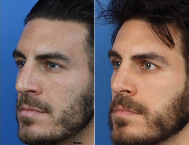 Before and After NatraNose by Dr. Philip Miller