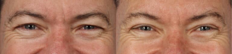 Upper Blepharoplasty with Dr. Miller