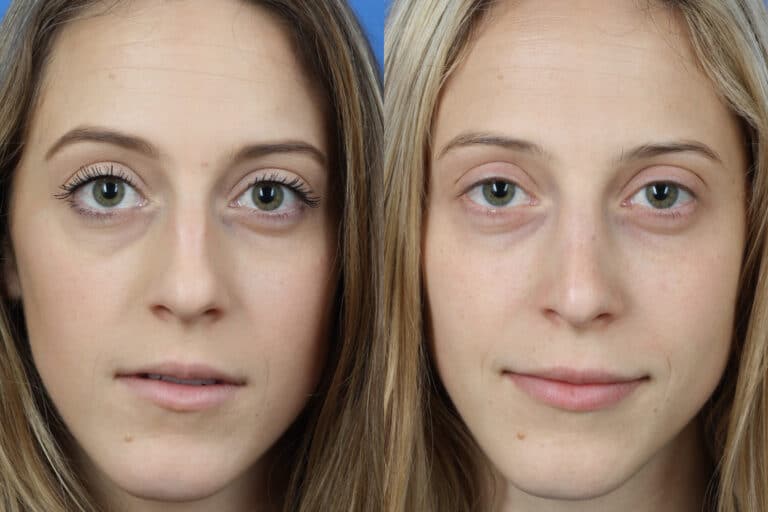 Rhinoplasty and Dermal Fillers with Dr. Miller