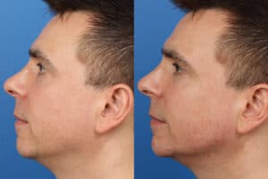 Gotham Plastic Surgery Male Facial Contouring New York NY