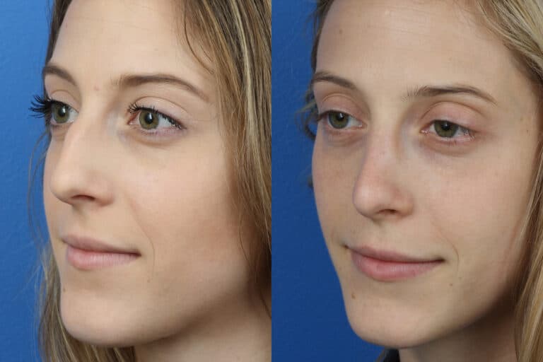 Rhinoplasty and Dermal Fillers with Dr. Miller