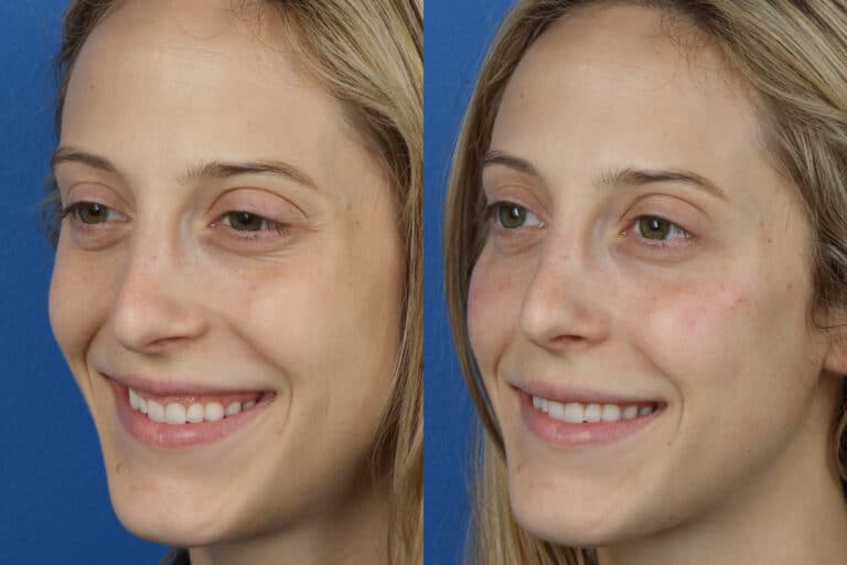 Rhinoplasty and Dermal Fillers with Dr. Miller