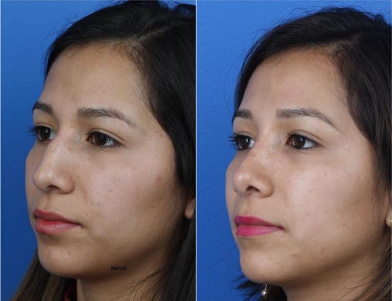 Rhinoplasty to Eliminate Dorsal Hump and Enhance Nose Shape by Dr. Miller