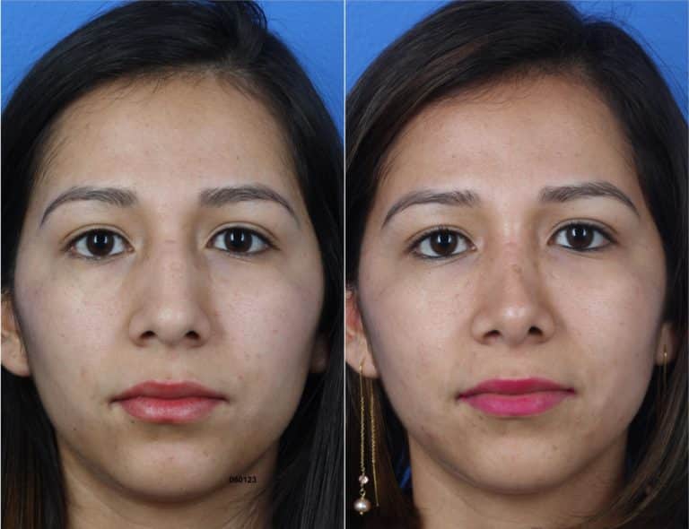 Rhinoplasty to Straighten Nasal Bridge by Dr. Miller