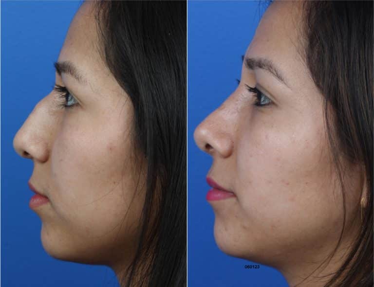Rhinoplasty to Remove Hump on Nasal Bridge and Refine Tip by Dr. Miller