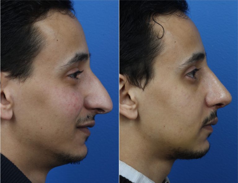 Rhinoplasty to Correct Nasal Bridge and Refine Profile by Dr. Miller