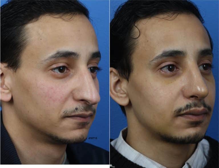 Rhinoplasty to Shorten Nose and Refine Tip by Dr. Miller