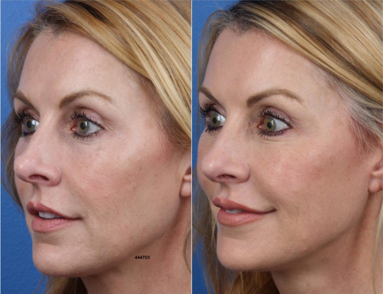 Rhinoplasty Using the NatraNose Technique by Dr. Miller