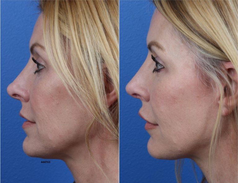 Rhinoplasty to Refine Nasal Tip and Enhance Facial Profile by Dr. Miller