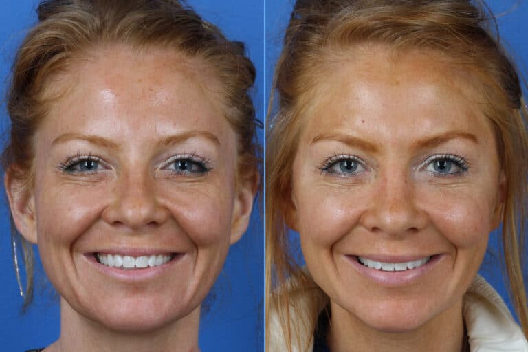 Micro Lift to Correct Skin Laxity and Aging Symptoms by Dr. Miller