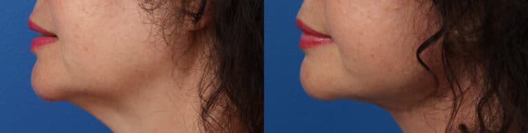Facelift and Neck Lift to Define the Jawline by Dr. Miller