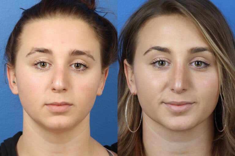 Rhinoplasty to Enhance Nose Shape by Dr. Miller