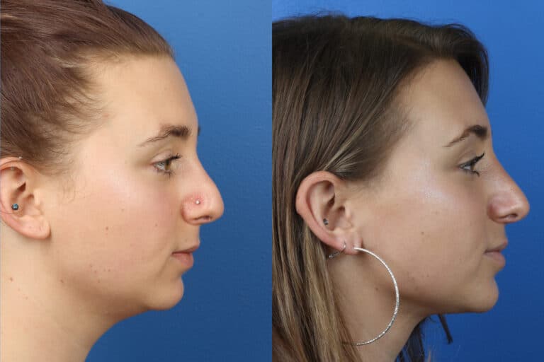 Rhinoplasty to Refine Nasal Bridge and Tip by Dr. Miller