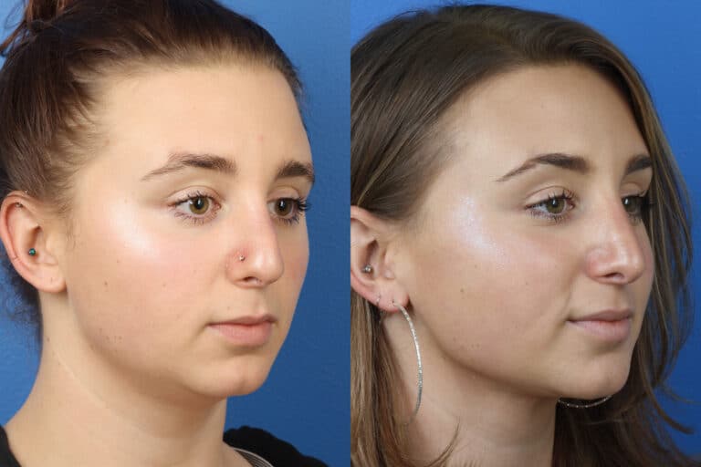 Rhinoplasty to Correct Nasal Bridge and Tip by Dr. Miller