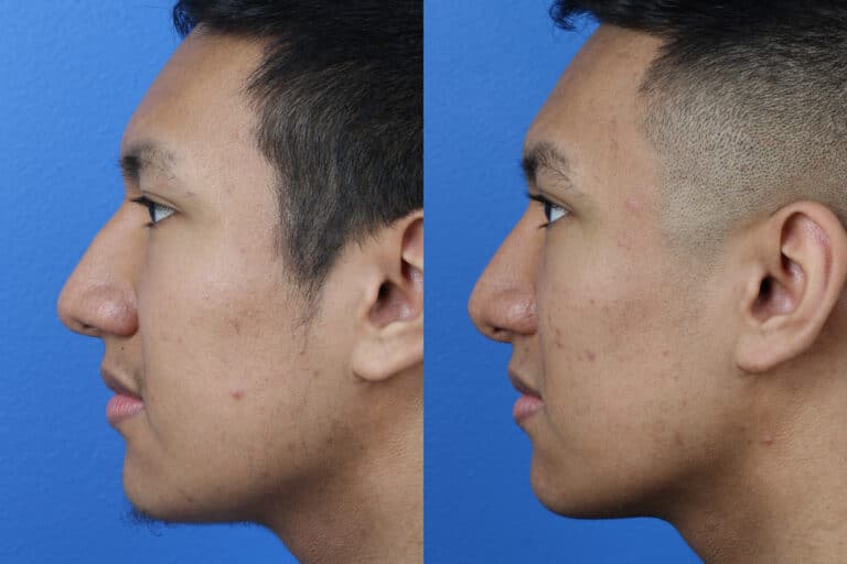 Rhinoplasty to Correct Nasal Bridge and Enhance Facial Profile by Dr. Miller