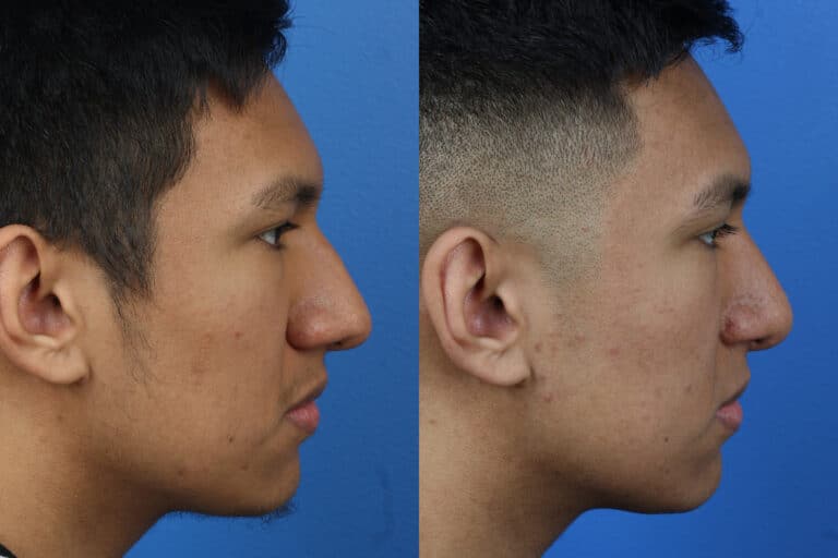 Rhinoplasty to Refine Nasal Bridge by Dr. Miller