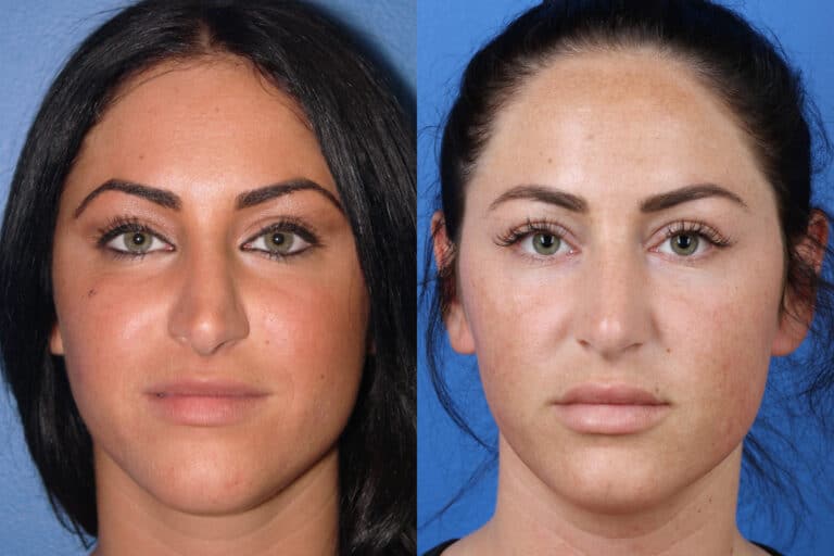 Rhinoplasty to Refine Nasal Tip by Dr. Miller