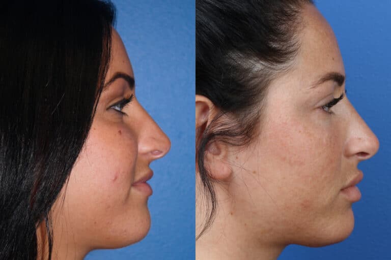 Rhinoplasty to Shorten Nasal Bridge and Refine Tip by Dr. Miller