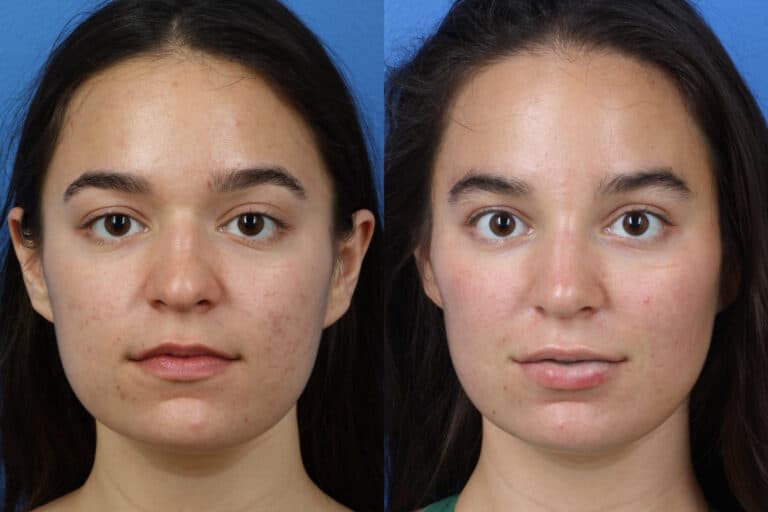 Rhinoplasty to Enhance Nose Shape and Size by Dr. Miller