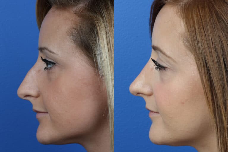 Rhinoplasty to Correct Dorsal Bump by Dr. Miller